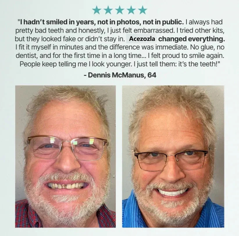 ✨New Year promotion: 70% discount 🎁 🦷 Acezozla™ Custom-Fit Fully Functional Dentures for a More Confident Smile!